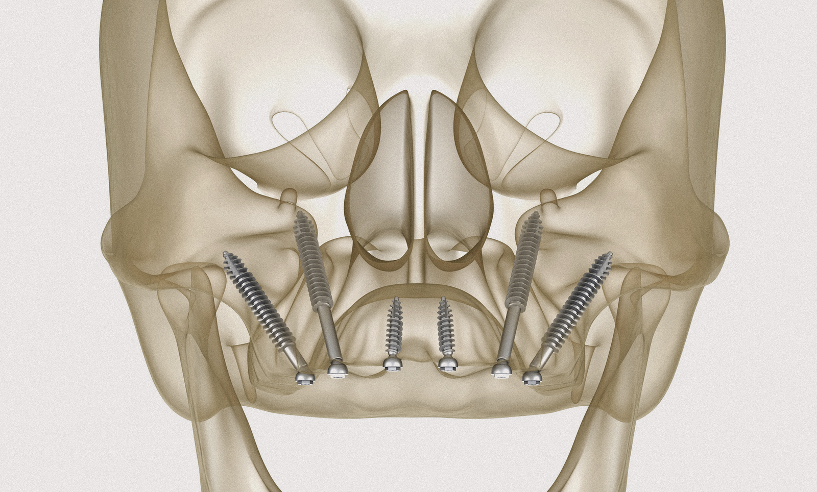 Impianti zigomatici - Implantologia Avanzata Studio Dentistico Crosara